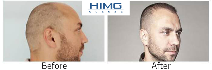 Before After hair transplant