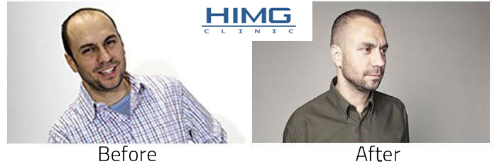 Hair transplantation – hair implantation photos