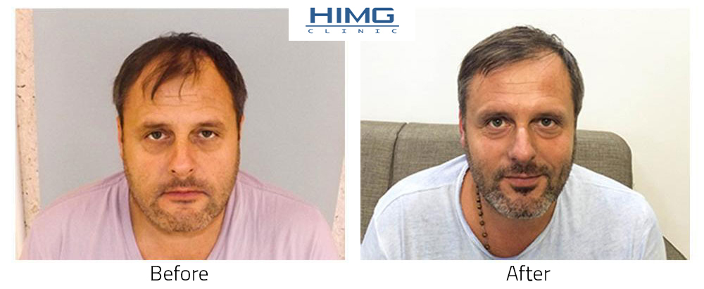 Hair transplantation – Hair implantation in Budapest Hair transplantation