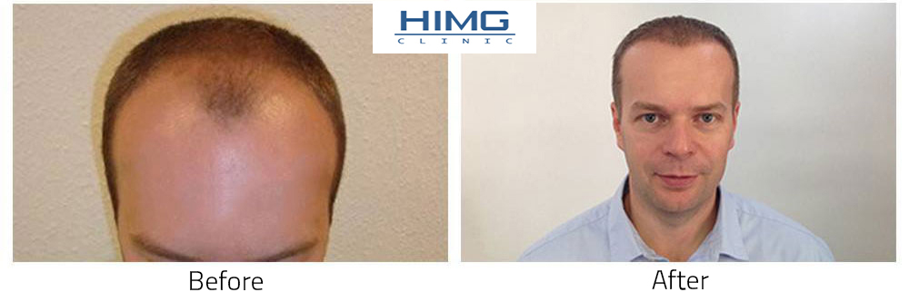Hair Transplantation Before - After Photos - Results Hair Transplantation Before - After Photos - Results
