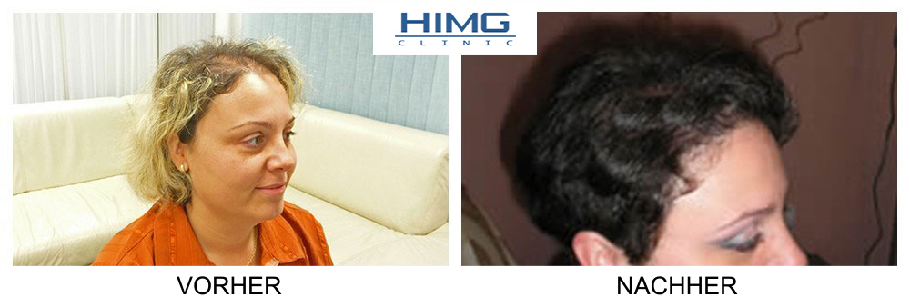 Hajbeültetés HIMG klinika Hajbeültetés HIMG klinika