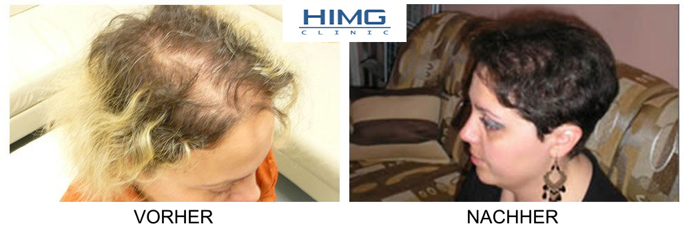 Hajtranszplantáció HIMG klinika Hajtranszplantáció HIMG klinika