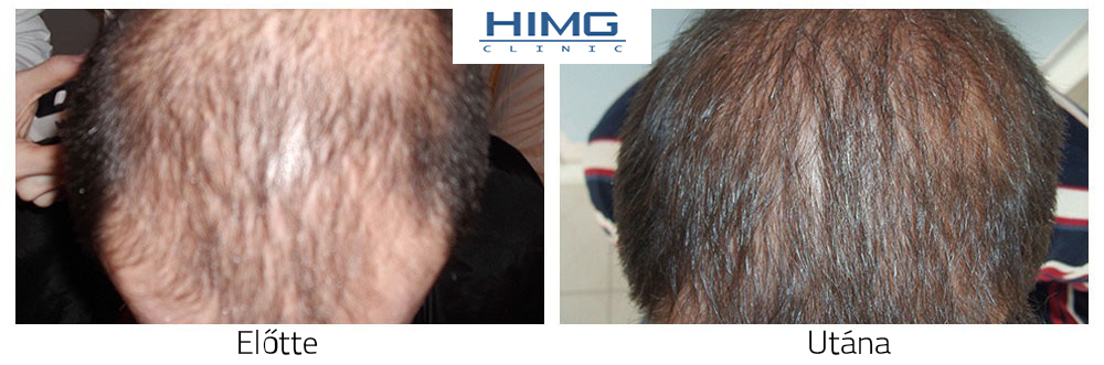 Hajbeültetés eredmények képek ,hajátültetés fotók