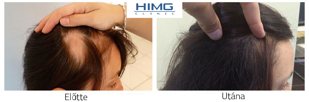 Hajbeültetés eredmények képek ,hajátültetés fotók