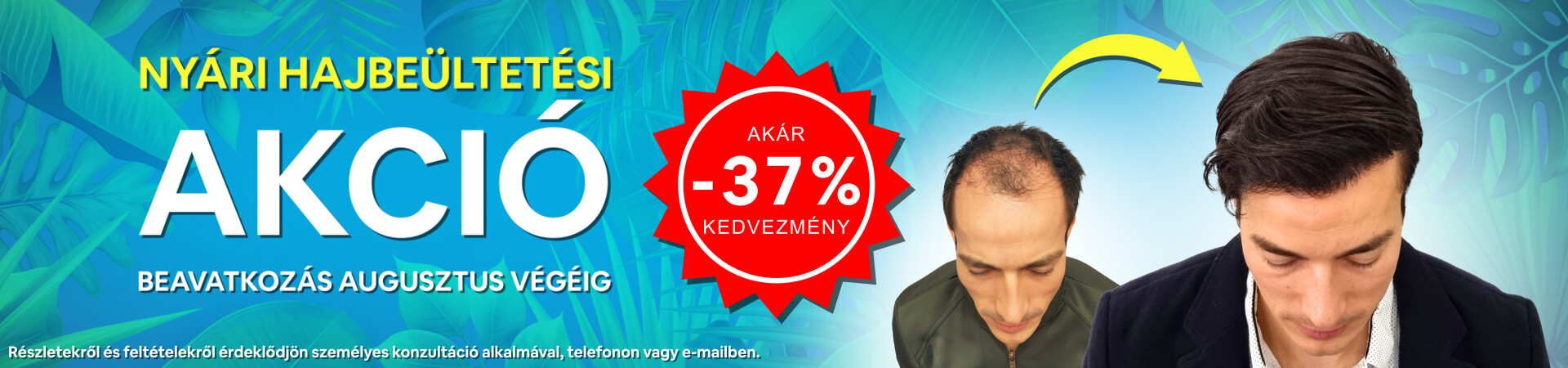 Nyári hajbeültetési akció - HIMG hajbeültetési klinika