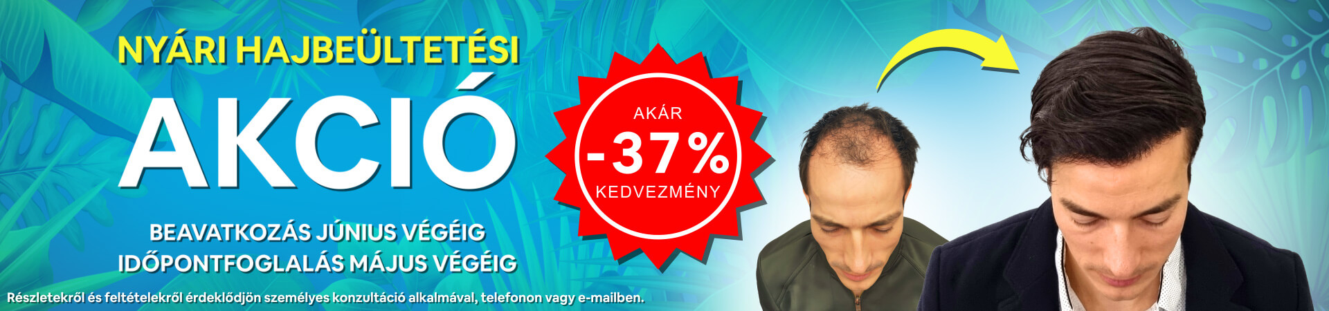 Nyári hajbeültetési akció a HIMG hajbeültetési klinikán!