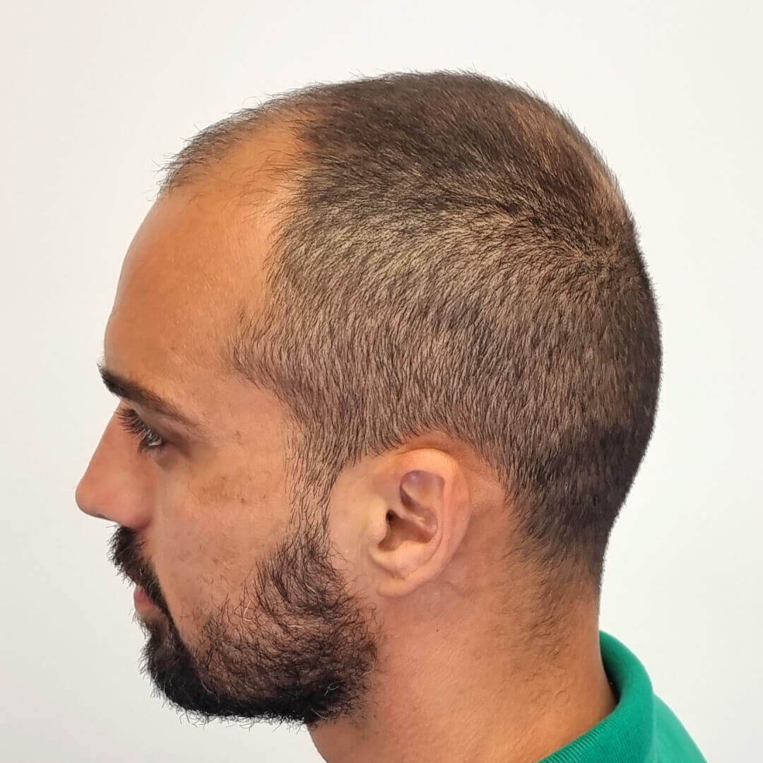 Hair Transplant before-after: Lucas - HIMG Hair Transplant Clinic Budapest, Hungary