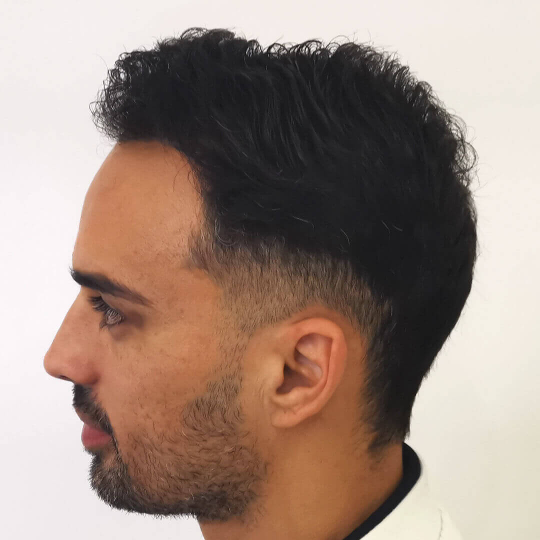 Hair Transplant before-after: Lucas - HIMG Hair Transplant Clinic Budapest, Hungary