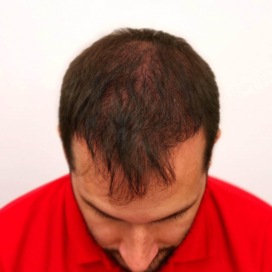 Hair Transplant before-after: Norbert - HIMG Hair Transplant Clinic Budapest, Hungary