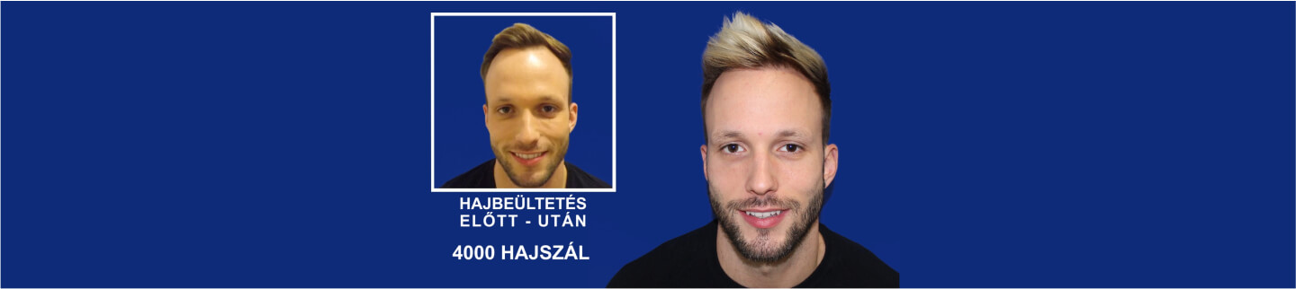 Előtte utána