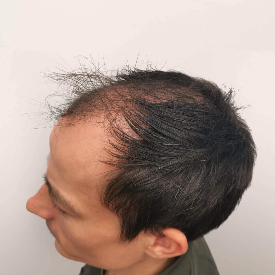 Hair Transplant before-after: Gergő - HIMG Hair Transplant Clinic