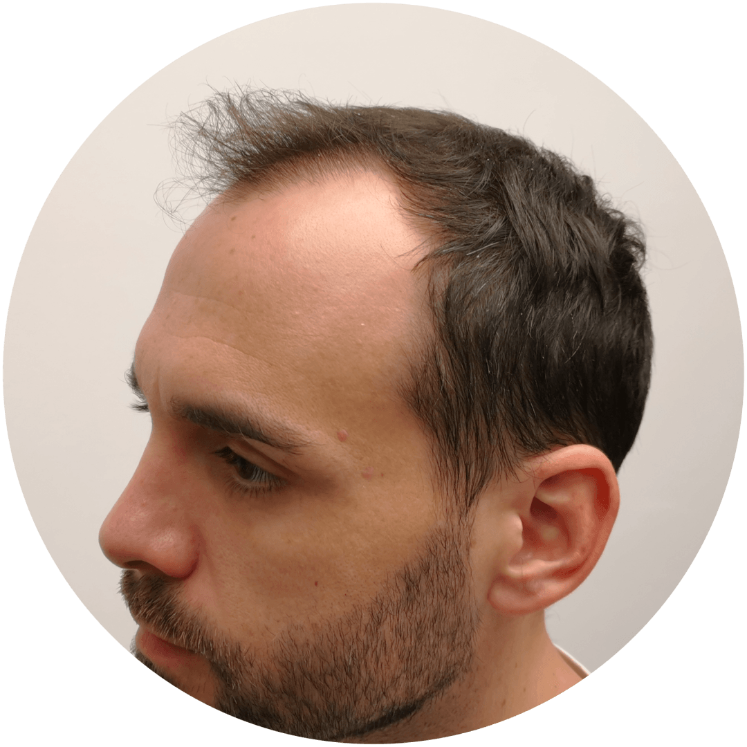 S.H.E. hajbeültetés előtt – ritkább hajvonal