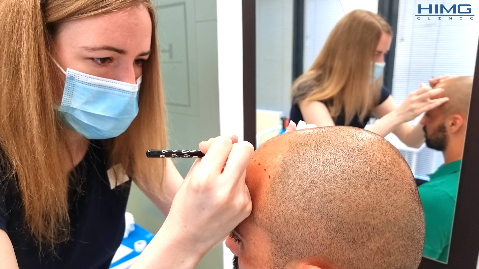 Hajvonal tervezése hajbeültetés előtt a HIMG Klinikán