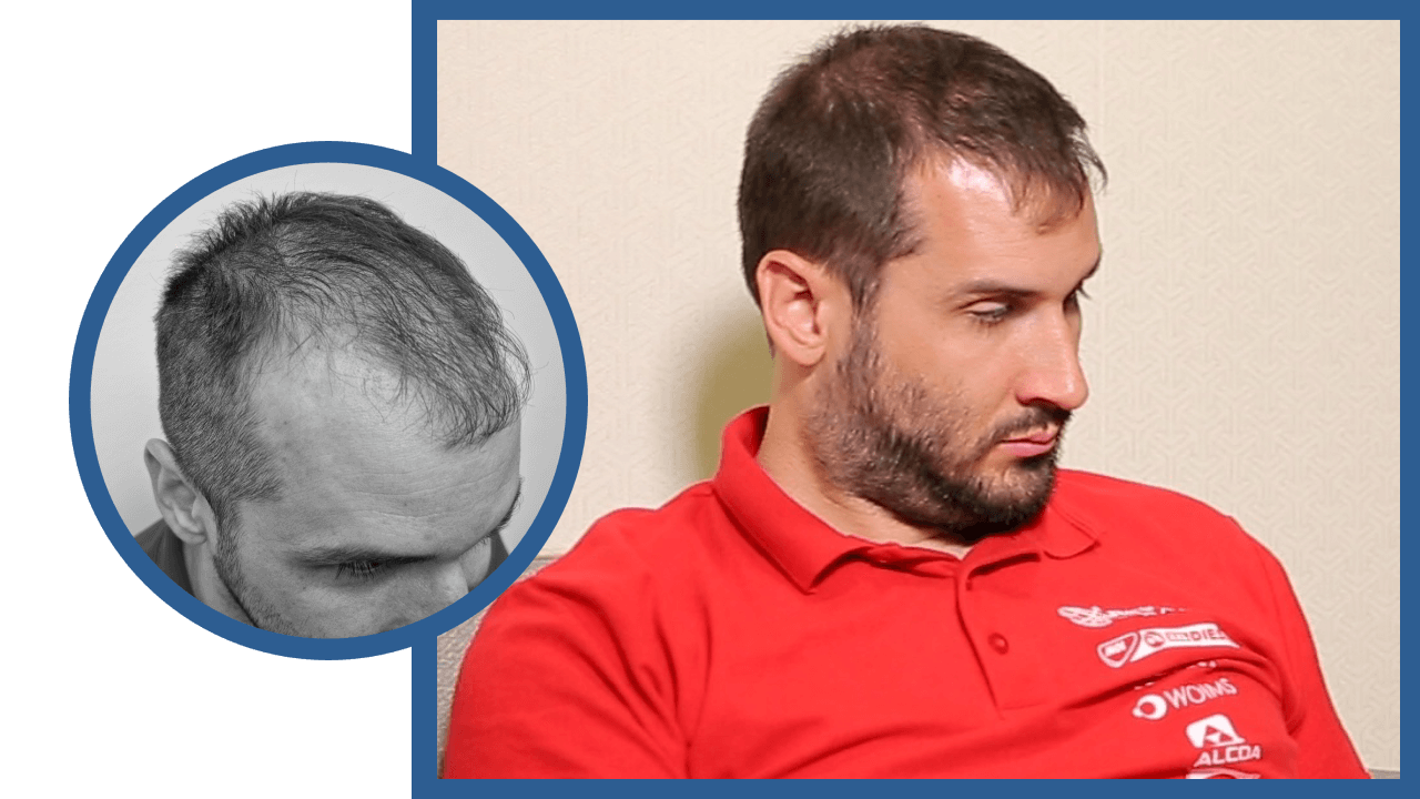 Hair implantation results - HIMG