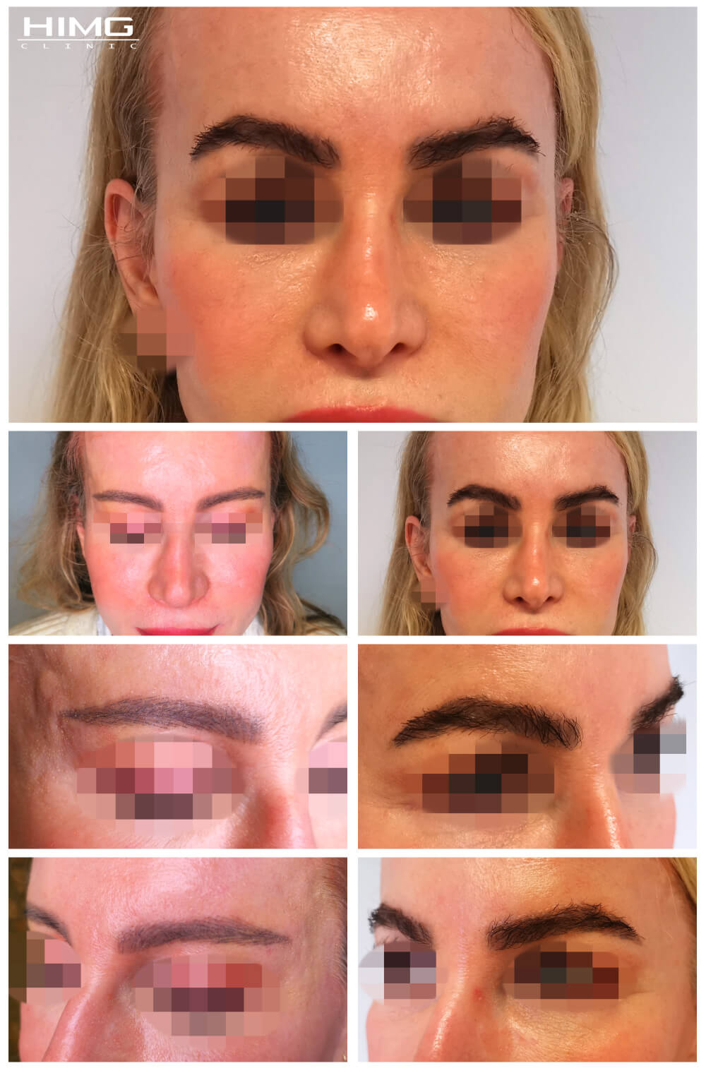 Szemöldök beültetés előtte-utána: Andrea - HIMG Klinika